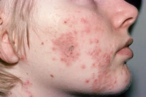 Kratom and acne- what to know